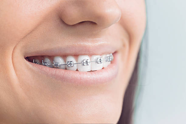 Dental Bonding in Sumner, WA